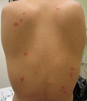 Bed-Bug-Bites-on-Back